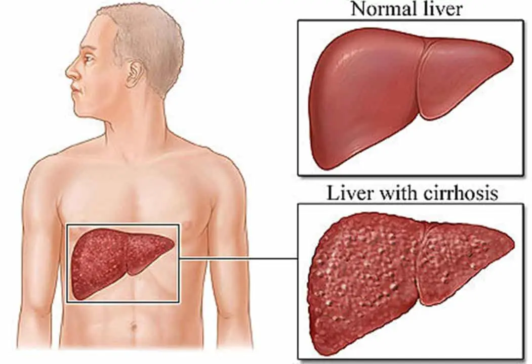 herbal remedies for cirrhosis