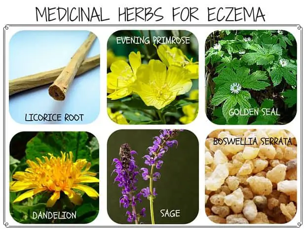 Herbs for Eczema - Uses, Treatment and Relief